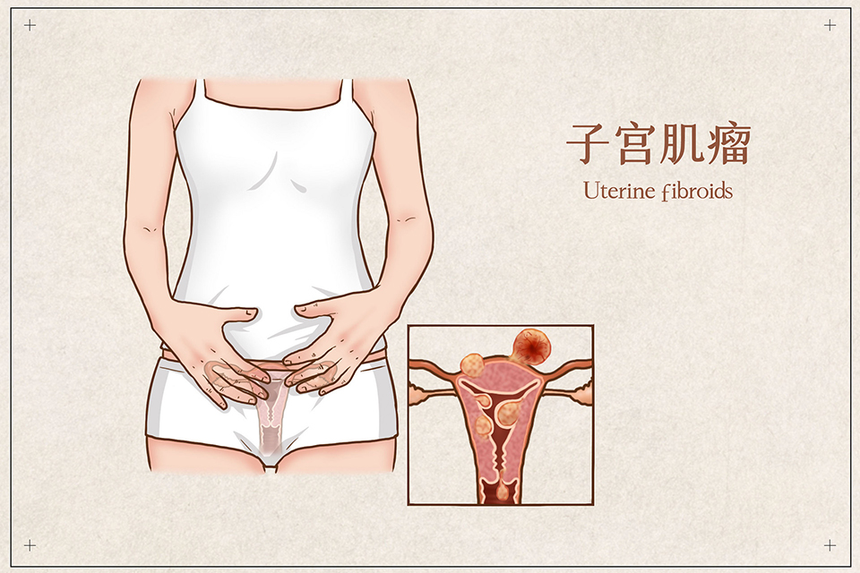 子宮肌瘤,壽險